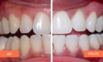 Что нужно знать о методике отбеливания зубов ЗУМ 4